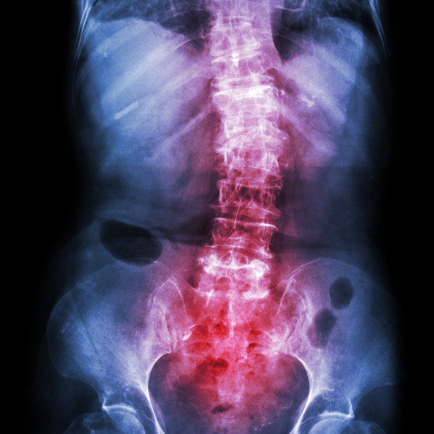 ankylosing spondylitis