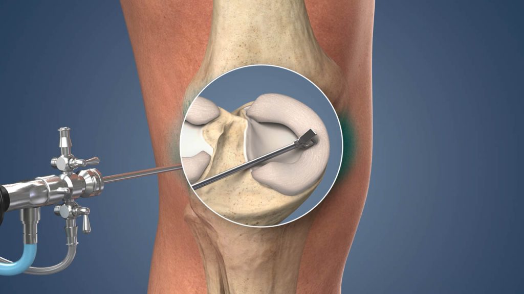 Stem one injection in knee for knee Pain treatment